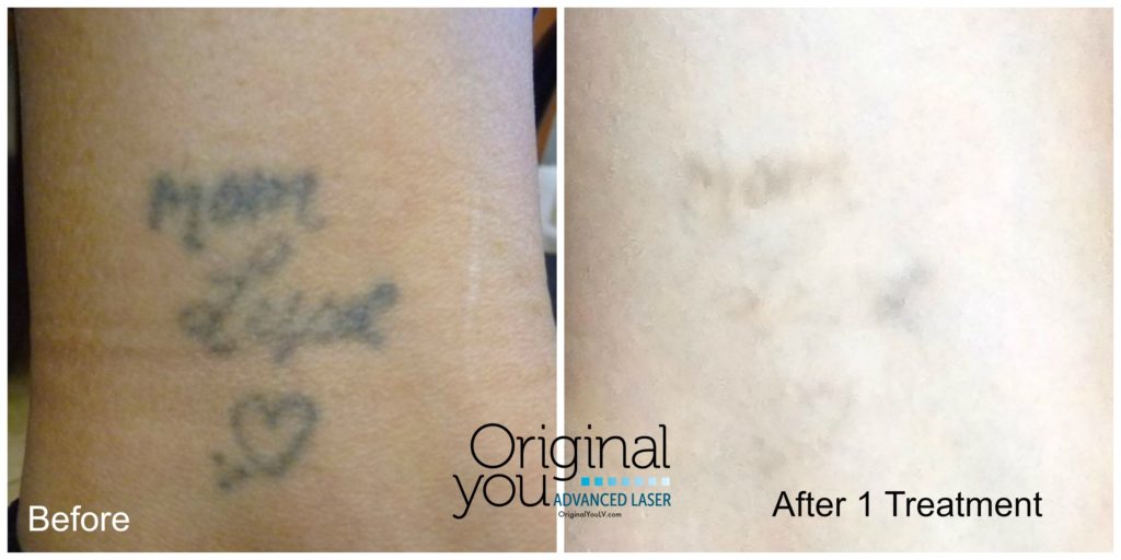 Tattoo Laser Removal Las Vegas Laser Tattoo Removal What To Expect Advanced Aesthetics Las