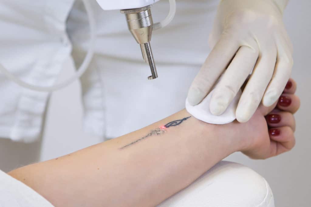 How Do You Care for a Tattoo Before & After a Laser Tattoo Removal  Treatment? - Original You